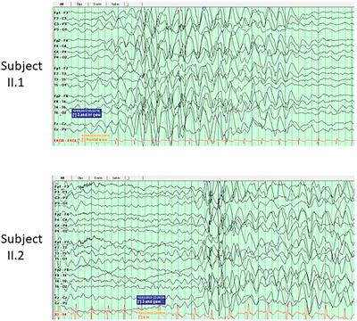 Intrafamilial variability in SLC6A1-related neurodevelopmental disorders